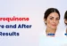 Hydroquinone Before and After Results