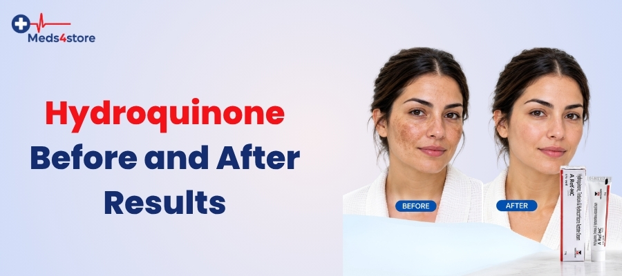 Hydroquinone Before and After Results